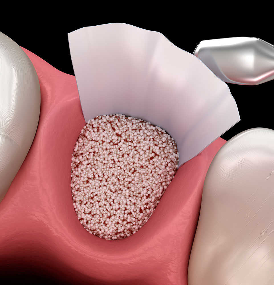 Bone Grafting
