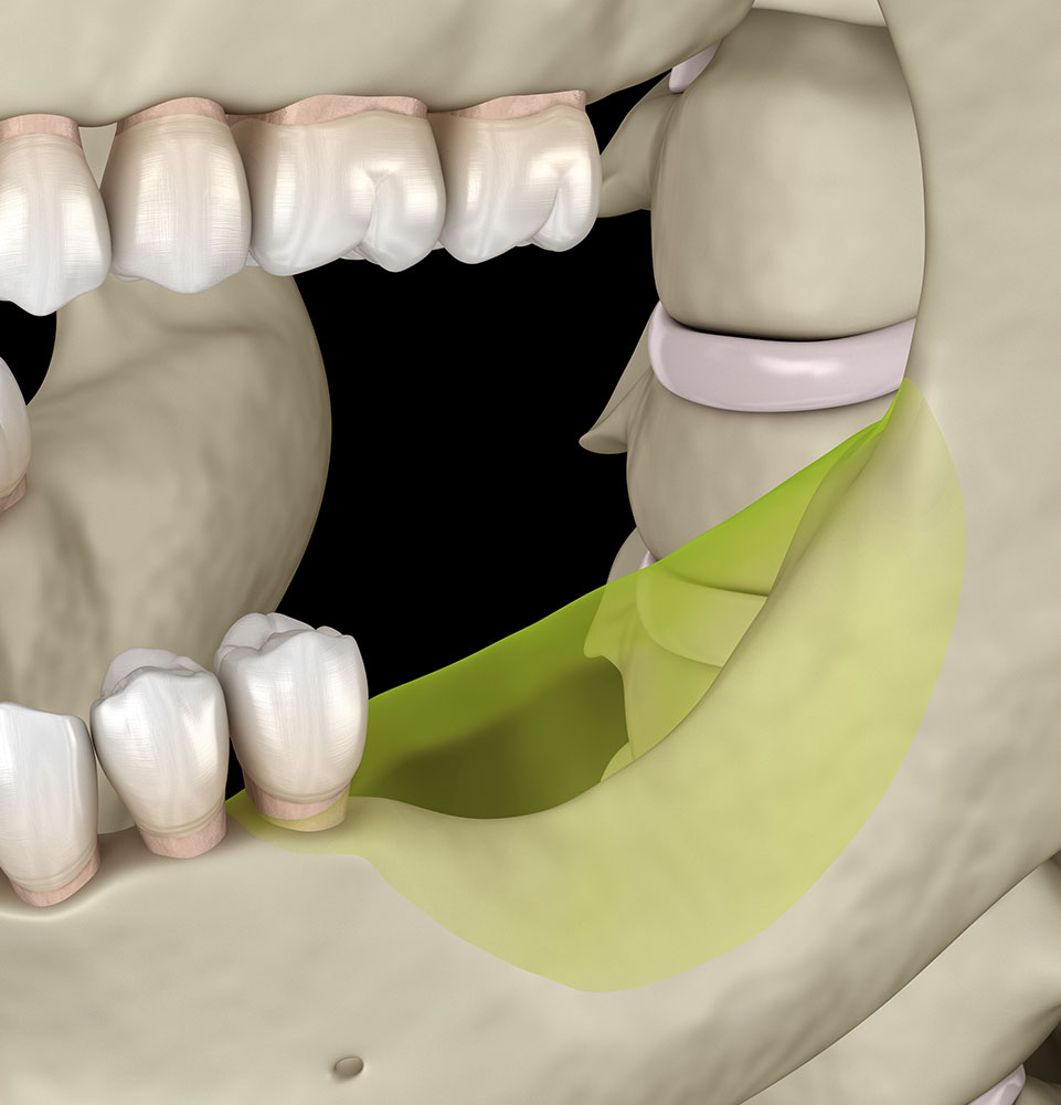 Bone Volume and Density Analysis