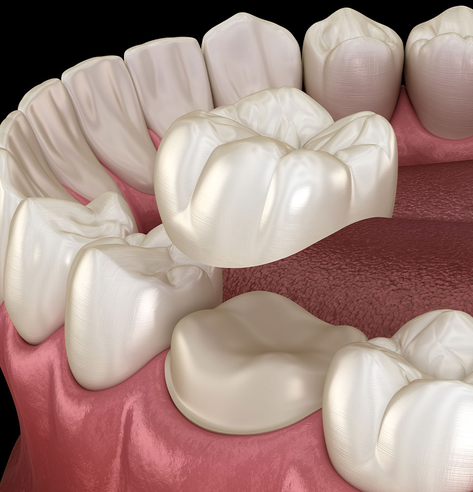 Implant-Supported Dentures