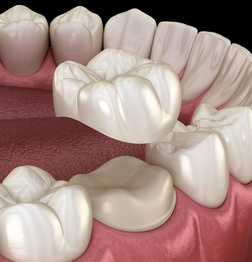 Dental Crowns and Bridges