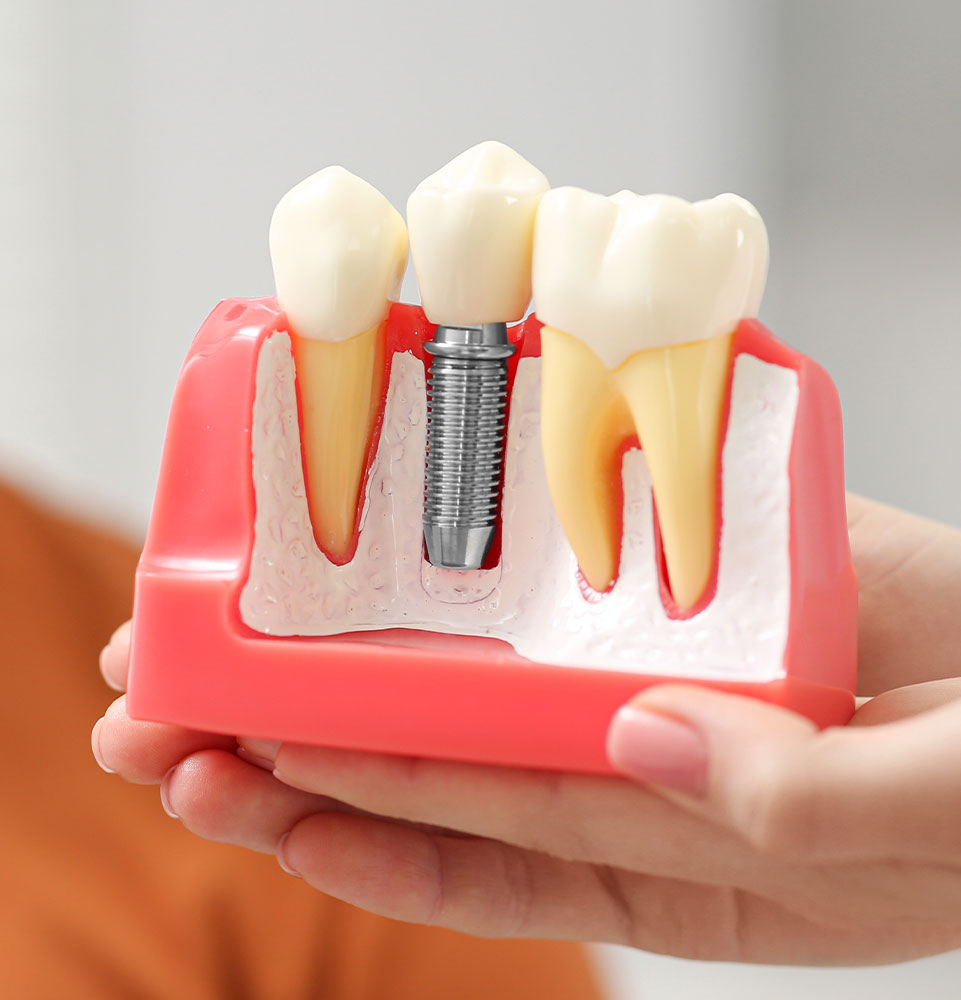 Dental Implant Surgery