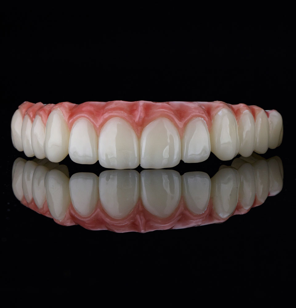 Full Arch Restoration