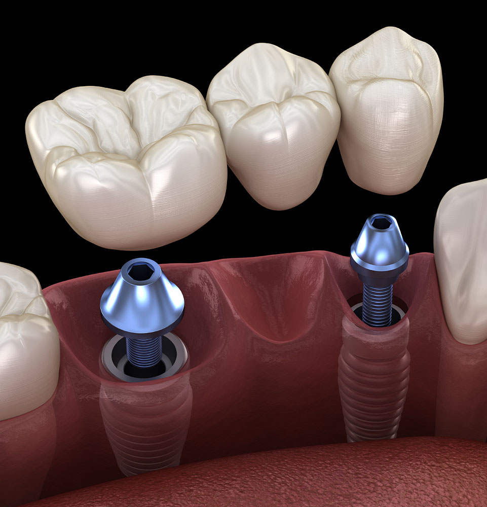 Implant-Supported Bridges
