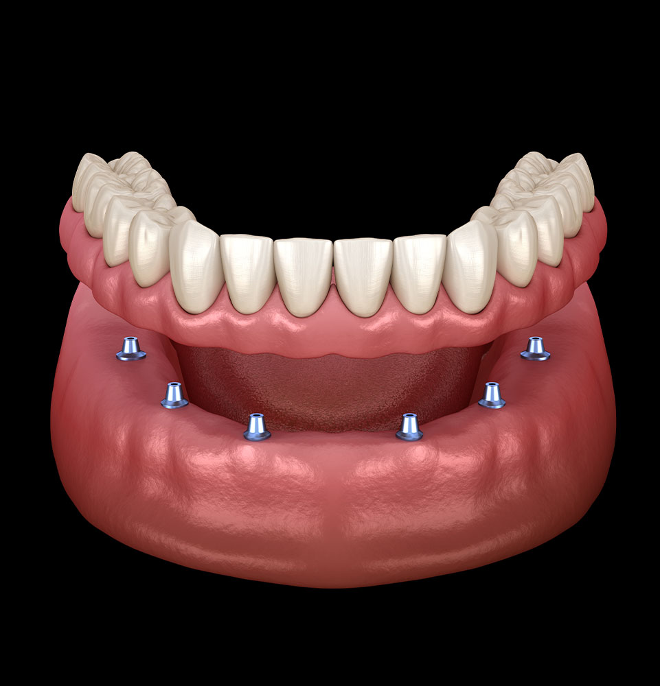 Implant Supported Dentures