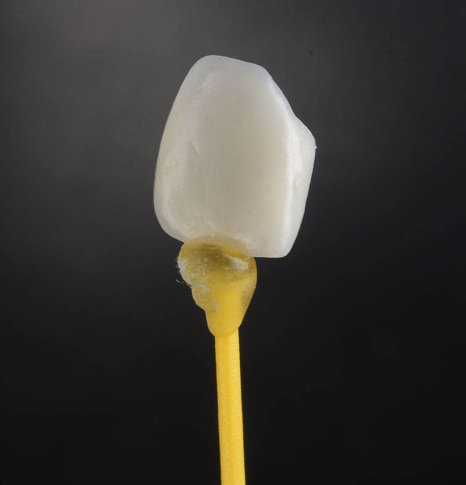Porcelain Veneers and Laminates