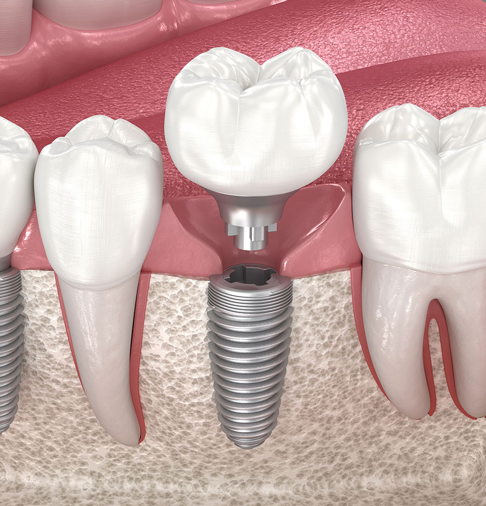 Single Tooth Implants
