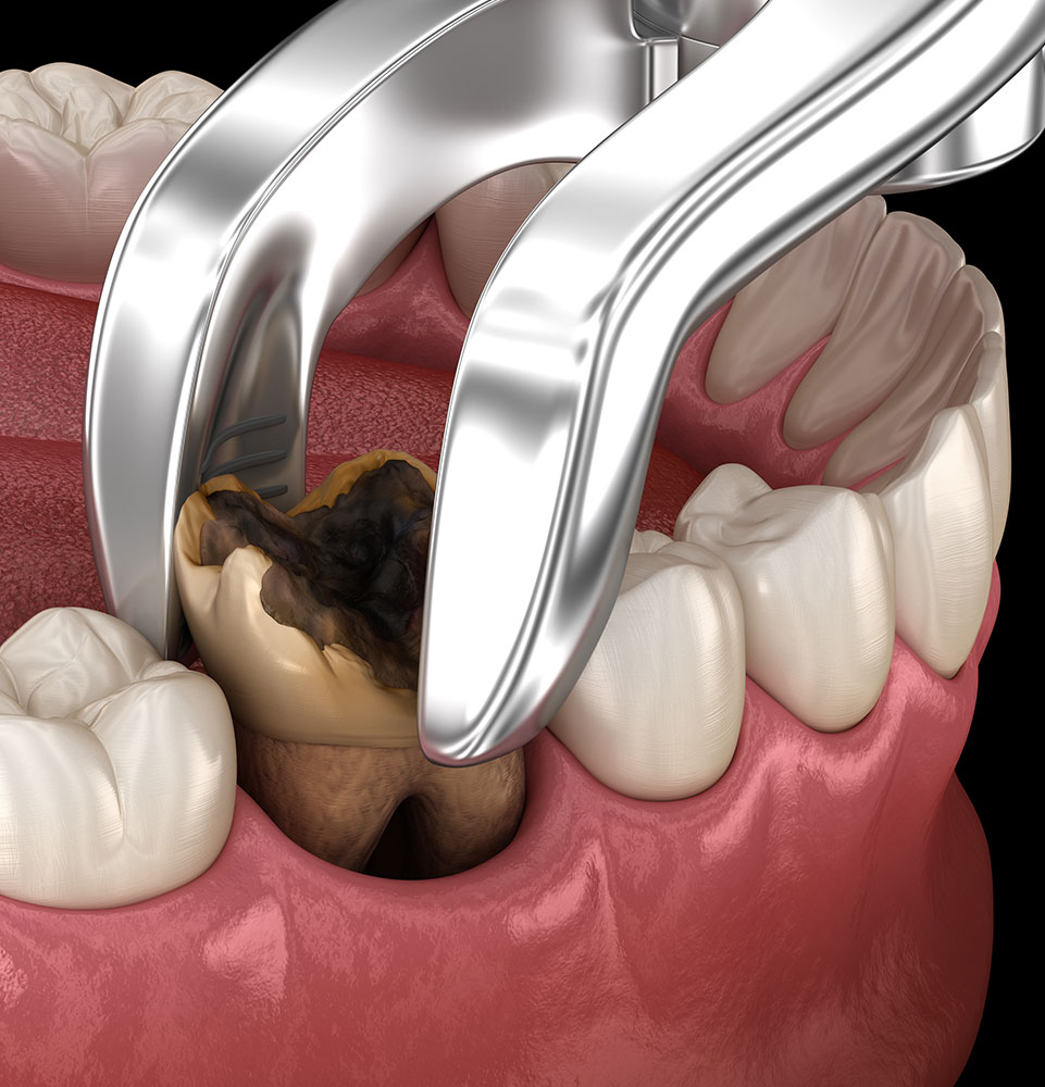 Tooth Extractions