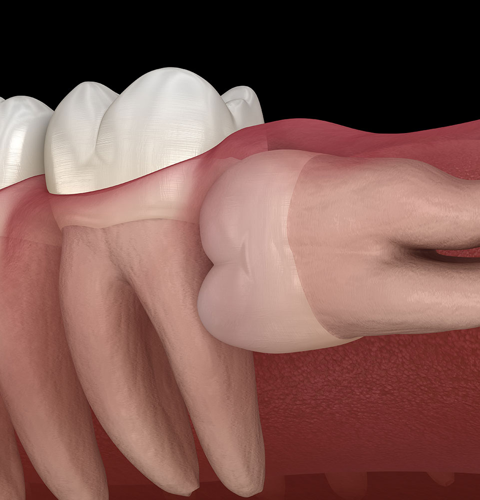 Wisdom Teeth Extractions