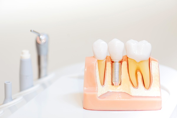 How Dental Implants Can Be Good For Your Jawbone