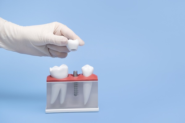 How Long Do Dental Implants Really Last?