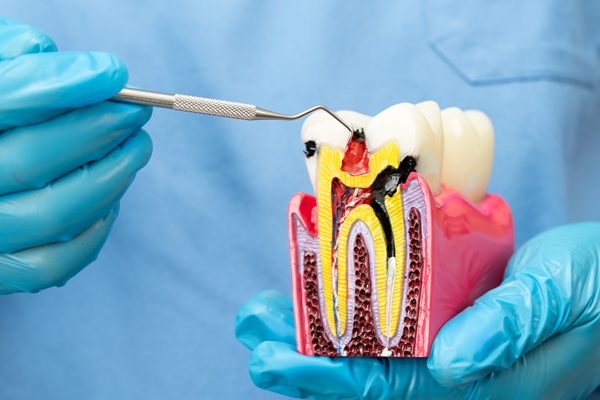 Common Reasons For Root Canal Therapy